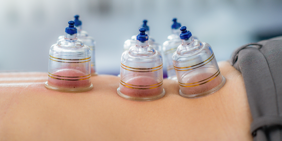 CUPPING